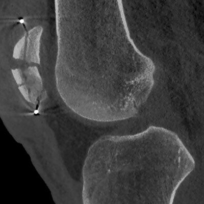 CT-DVT - 7G - Multi-Scan-Body - Beispielbild 1 - Professor Citak Gesundheitszentrum - Orthopädie - Hamburg